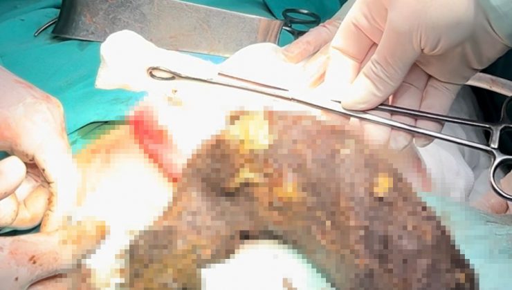 KARNINDAN 2 KİLOGRAM KIL YUMAĞI ÇIKTI  